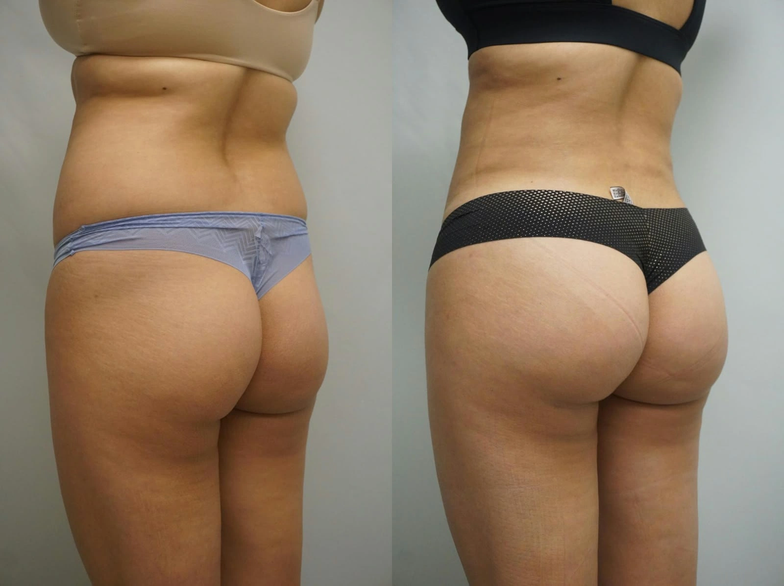 Resultado real de harmonização de bumbum - imagem 1