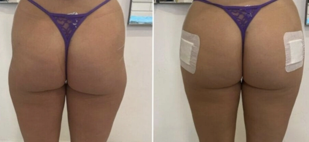 Resultado real de harmonização de bumbum - imagem 2
