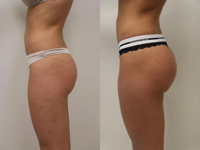 Resultado real de harmonização de bumbum - imagem 3